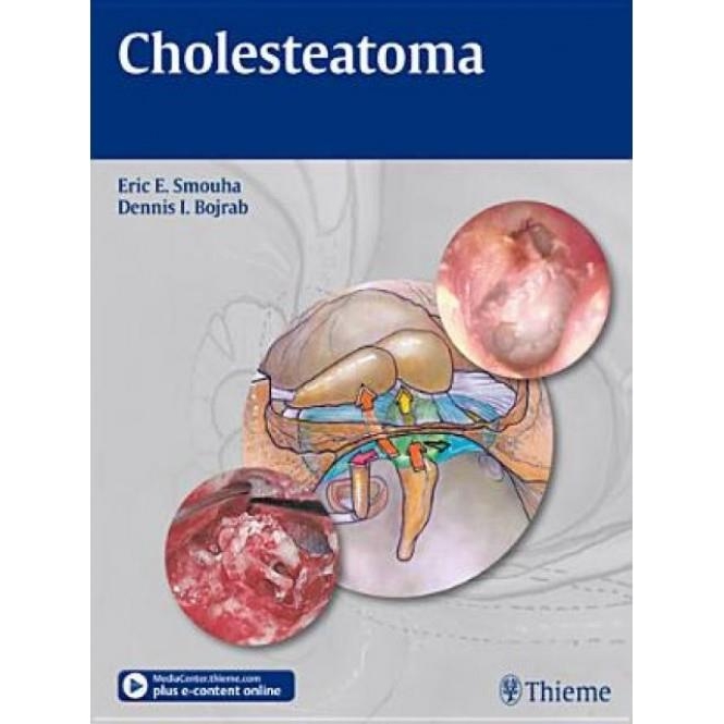 Cholesteatoma