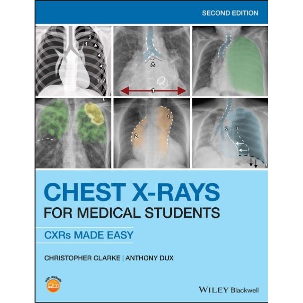 Chest X-Rays for Medical Students CXRs Made Easy 2nd Edition