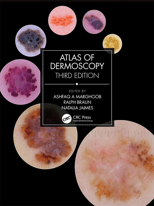 Atlas of Dermoscopy, 3rd Edition