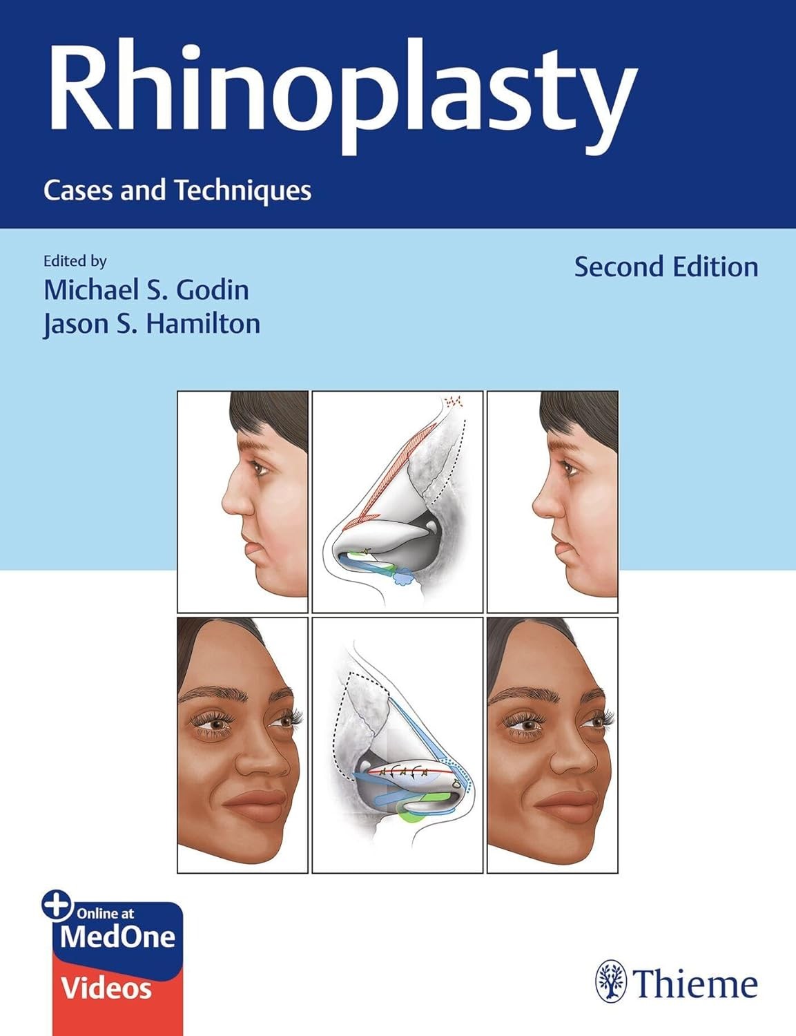 Rhinoplasty: Cases and Techniques, 2nd Edition