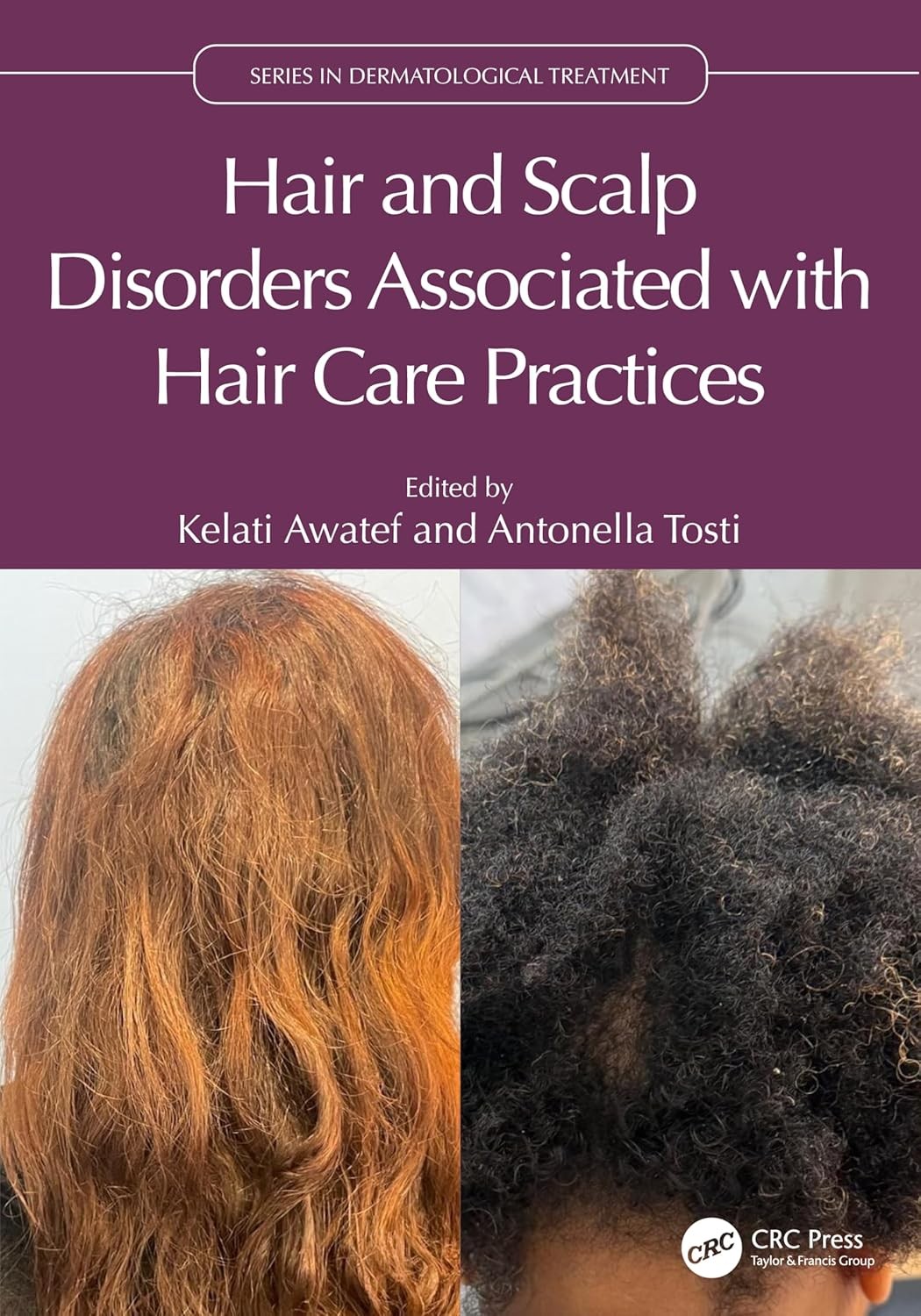 Hair and Scalp Disorders Associated with Hair Care Practices