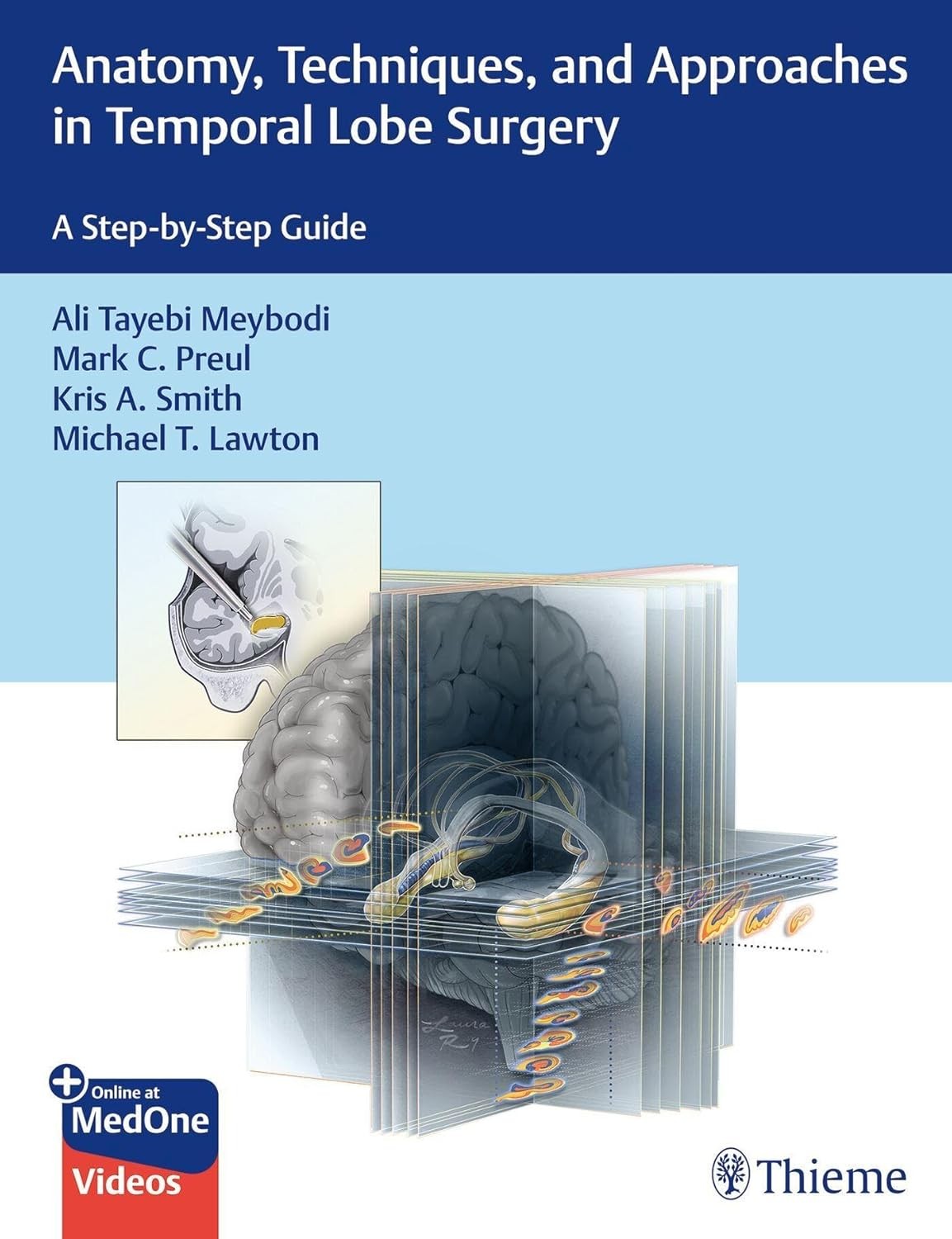 Anatomy, Techniques, and Approaches in Temporal Lobe Surgery: A Step-by-Step Guide