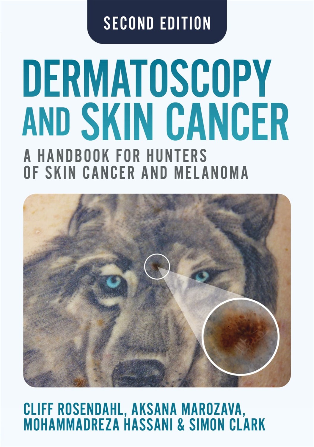 Dermatoscopy and Skin Cancer, 2nd edition A handbook for hunters of skin cancer and melanoma