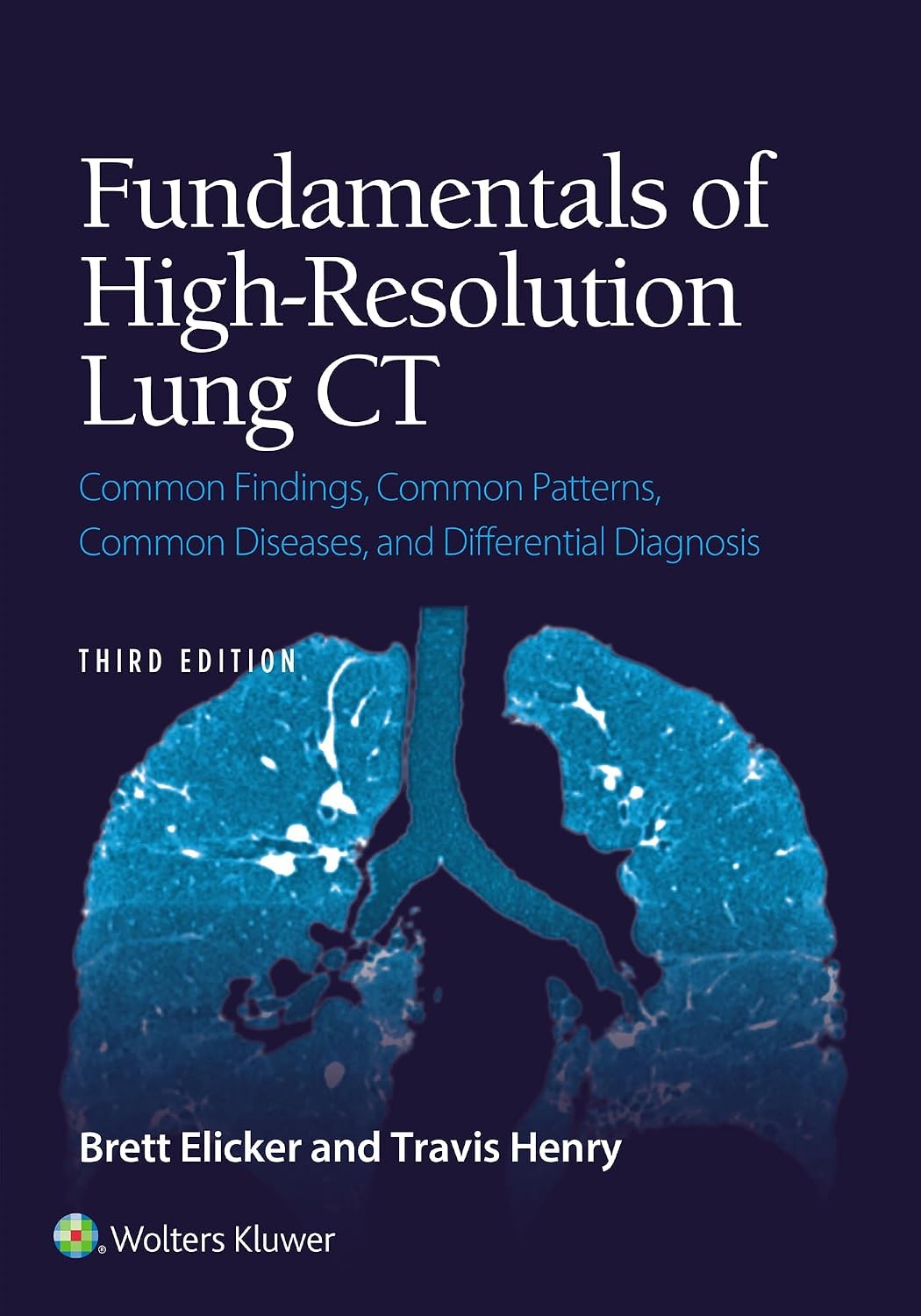 Fundamentals of High-Resolution Lung CT: Common Findings, Common Patterns, Common Diseases, and Differential Diagnosis