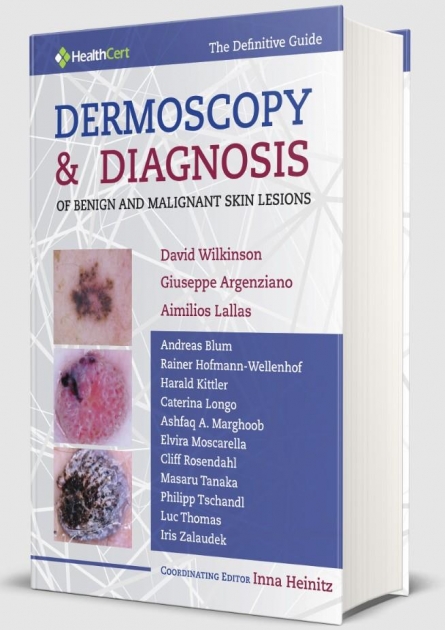 Dermoscopy & Diagnosis  of Benign and Malignant SKIN Lesions