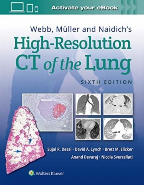 Webb, Muller and Naidich`s High-Resolution CT of the Lung 6th edition