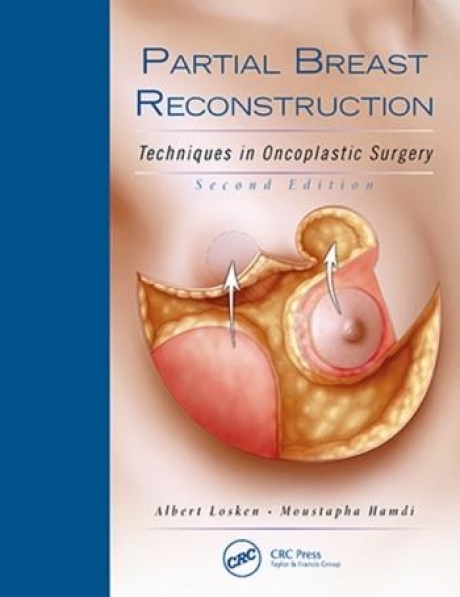 Partial Breast Reconstruction: Techniques in Oncoplastic