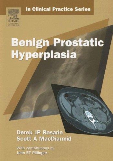 Benign Prostatic Hyperplasia, 1st Edition