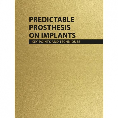 Predictable Prosthesis on Implants, key points and techniques