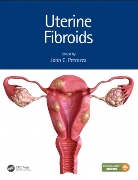 Uterine Fibroids