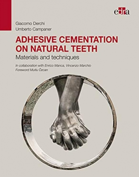 Adhesive cementation on natural teeth. Materials and techniques 1st Edition