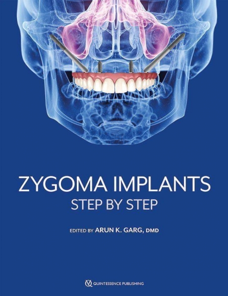 Zygoma Implants, Step by Step, 1st Edition