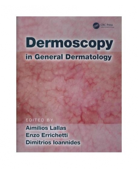 Dermoscopy in General Dermatology, 1st Edition