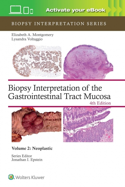 Biopsy Interpretation of the Gastrointestinal Tract Mucosa Volume 2: Neoplastic, 4th Edition