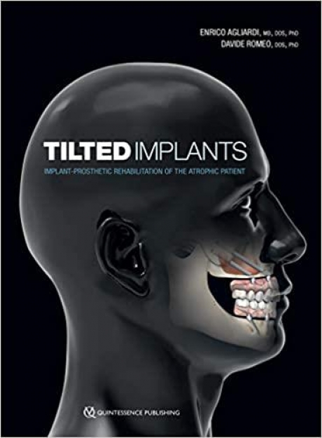 Tilted Implants (Implant-Prosethetic Rehabilitation of the Atrophic Patient)