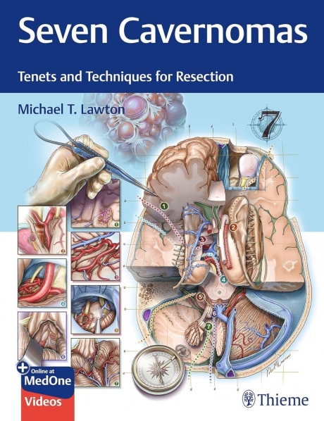 Seven Cavernomas: Tenets and Techniques for Resection