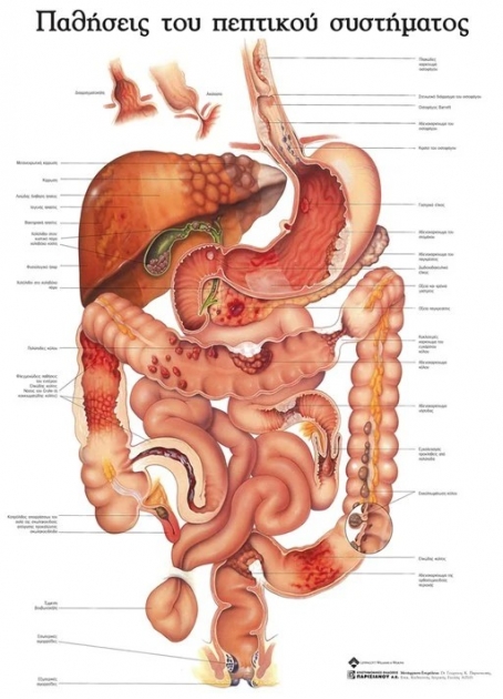 Ανατομικός Χάρτης: Παθήσεις του Πεπτικού Συστήματος