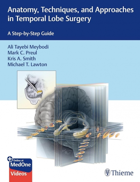 Anatomy, Techniques, and Approaches in Temporal Lobe Surgery: A Step-by-Step Guide