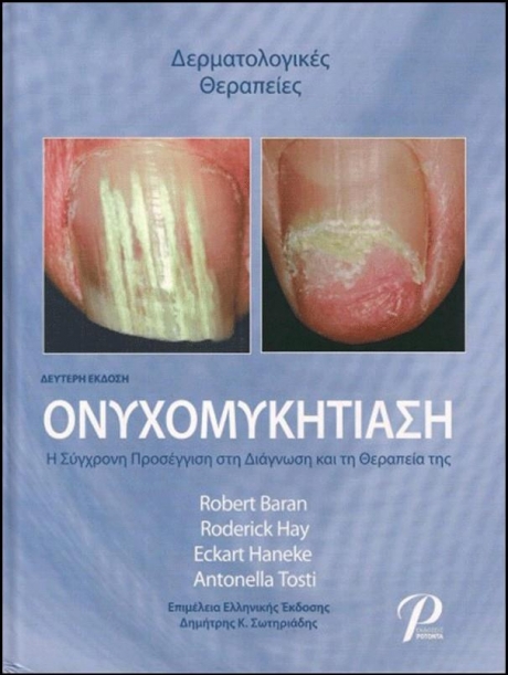 Ονυχομυκητίαση, 2η Έκδοση