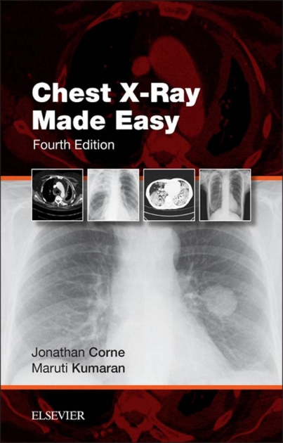 Chest X-Ray Made Easy, 4th Edition